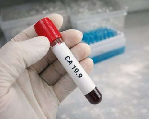 New blood test markers may spot pancreatic cancer earlier — and beat CA19-9 alone
